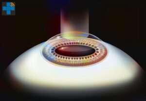PKR : illustration du traitement par laser Excimer